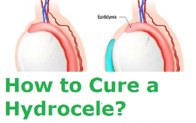 How to Cure a Hydrocele