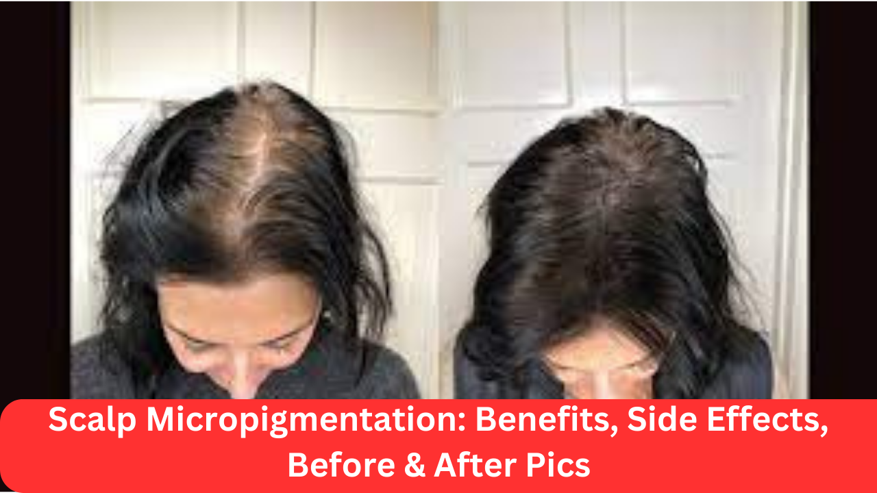 Scalp Micropigmentation: Benefits, Side Effects, Before & After Pics